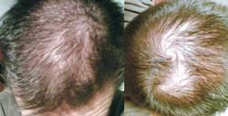 Alopecia o caida del cabello | Patologias Dermatologicas